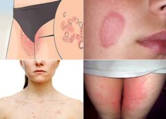 बारिश में दाद-खुजली और Skin Infection से बचना है? एक्सपर्ट्स ने दी ये सलाह